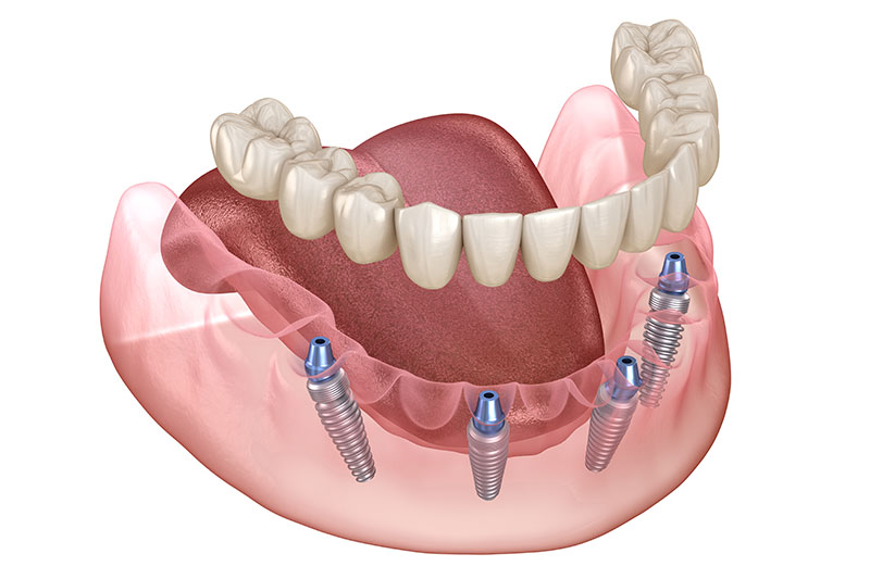 All on 4 Dental Implants in Visalia