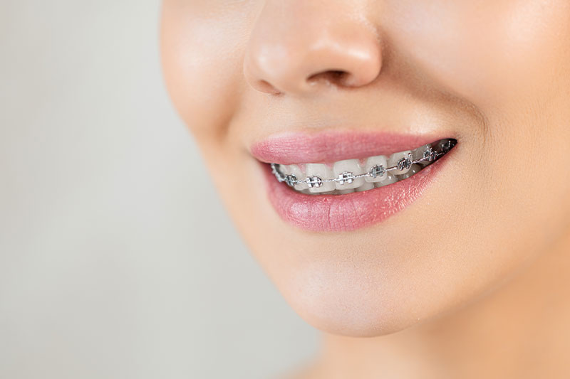 Braces in Visalia