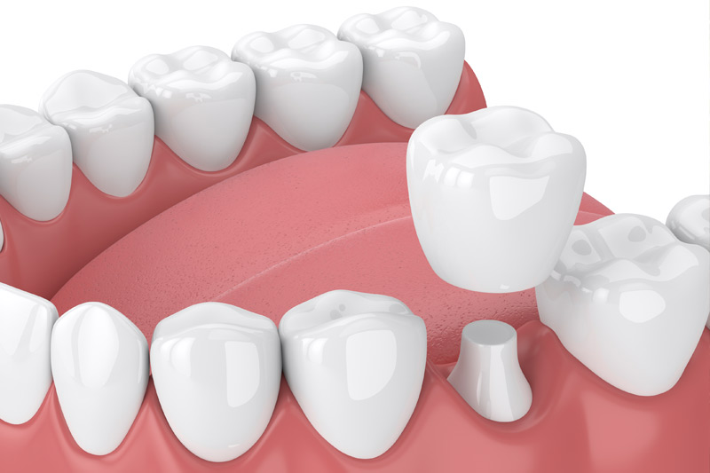Dental Crowns in Visalia