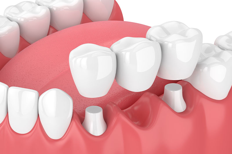 Dental Bridges in Visalia