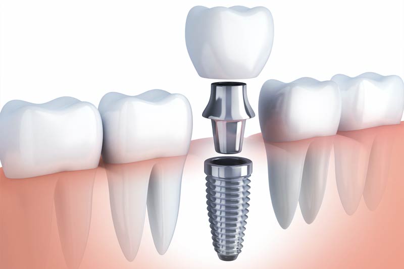 Dental Implants in Visalia