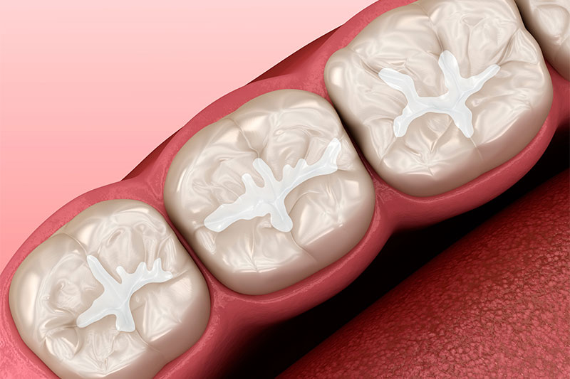 Dental Bonding in Visalia