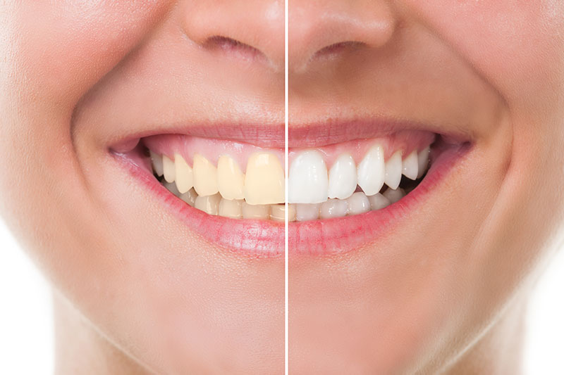 Teeth Whitening in Visalia