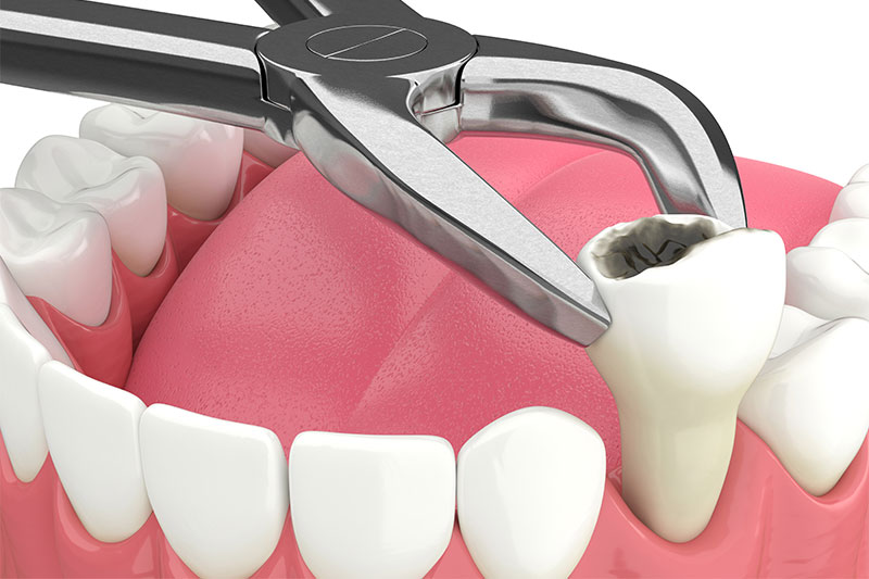 Tooth Extractions in Visalia