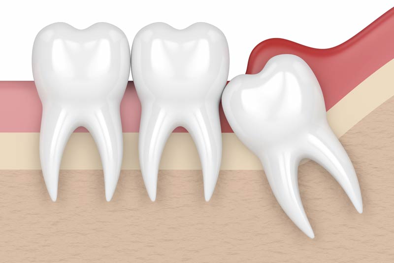 Wisdom Tooth Removal in Visalia